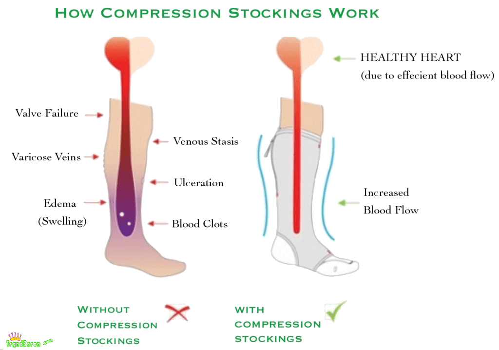 how compression socks work with blood circulation