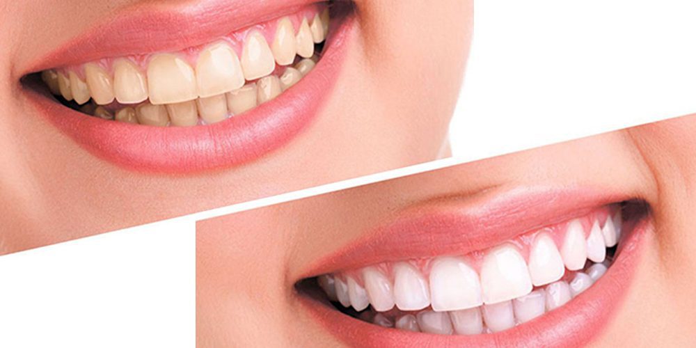 how to get whiter teeth teeth whitening